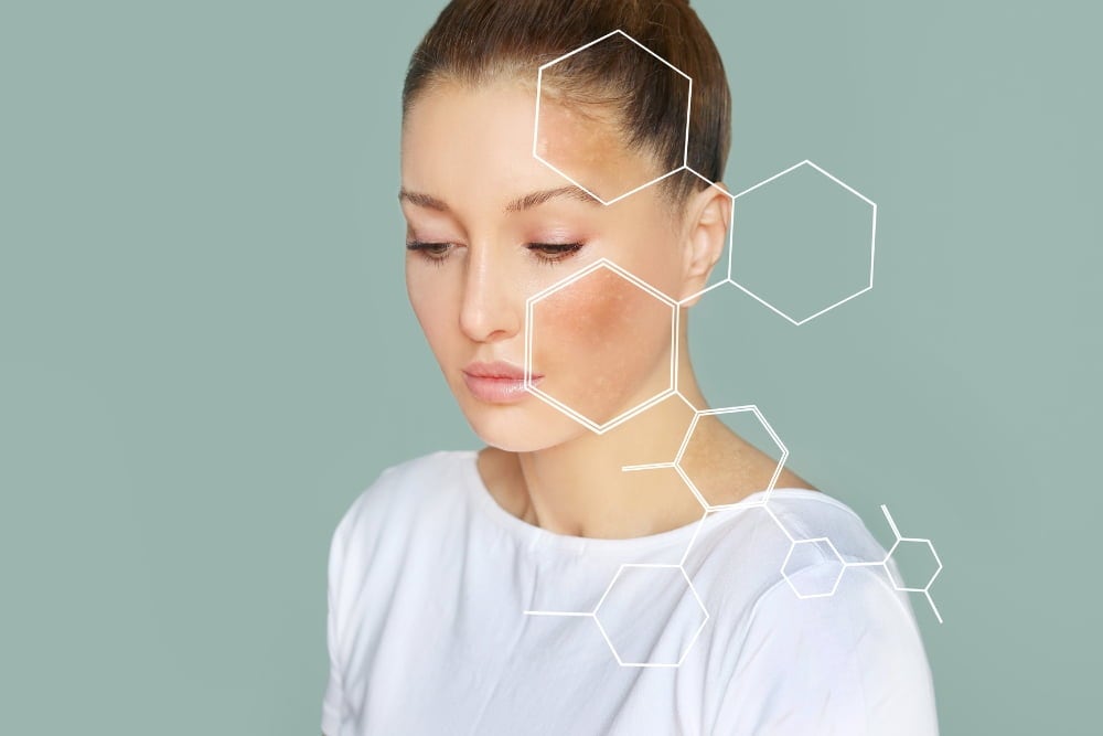 How To Treat Eczema